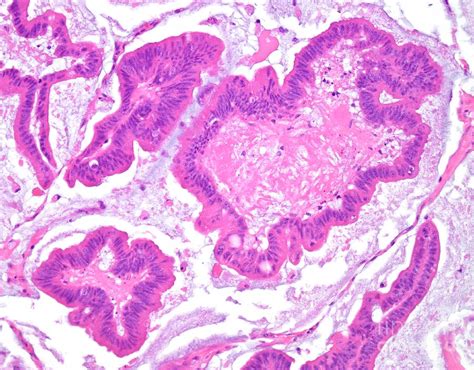 Mucinous Carcinoma Of The Colon Photograph by Webpathology/science ...