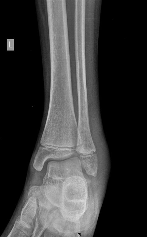 Lateral Malleolus Fracture