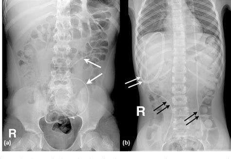 Figure 3 from Is shunt series X-ray necessary before revision of ...