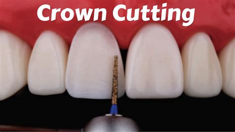 crown preparation for anterior teeth Archives - Dental Clinic