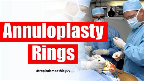 Annuloplasty Rings