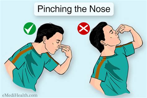 How to Stop a Nosebleed: Treatment and Home Remedies