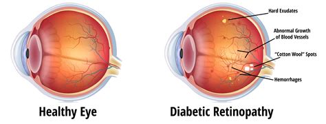 Diabetic Retinopathy – EyeCare Associates of South Tulsa