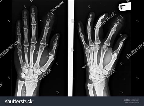 Anteroposterior Oblique View Hand Wrist Xray Stock Photo 1499423201 ...