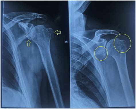 Greater Tubercle