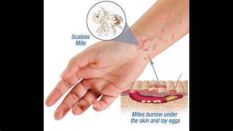 Scabies: What you need to know about it – AIR-CLINIC