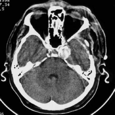 Cerebral Aneurysm Ct