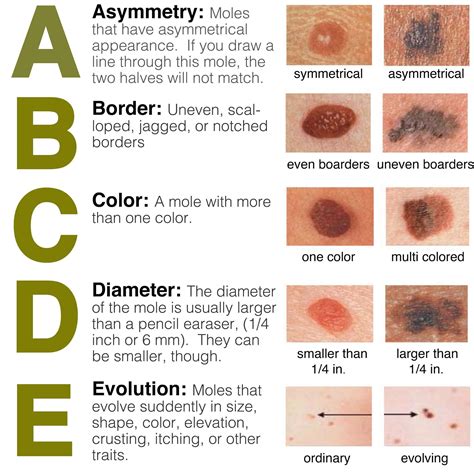 Abcde Rule Of Skin Cancer Detection