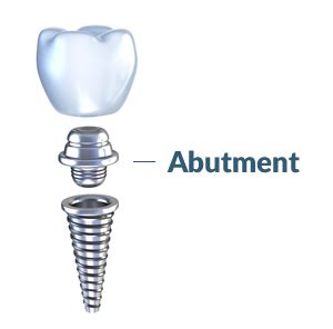 Elk Grove Custom Dental Implant Abutment | Sacramento