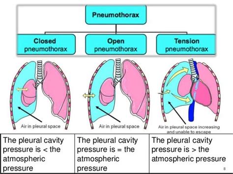 Spontaneous vs. Tension Pneumothorax