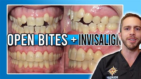 Invisalign Open Bite Treatment! [BEFORE & AFTER] - YouTube