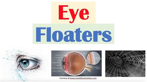 Eye Floaters (Vitreous Floaters) | Causes, Risk Factors, Associated ...