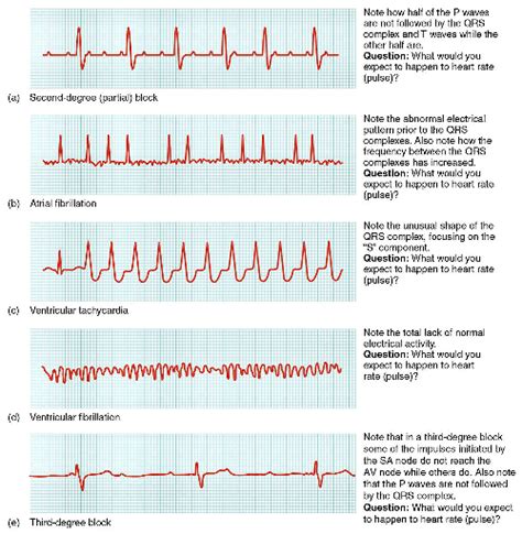 Cardiac Arrhythmia: Symptoms Treatment - Phlebotomy Career Training