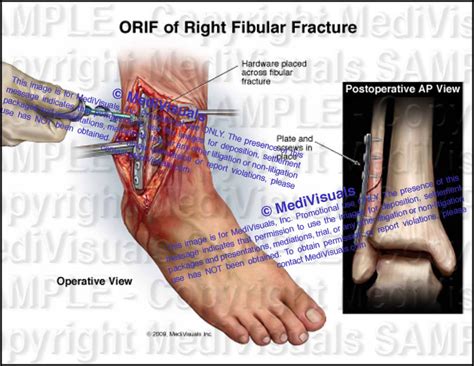 ORIF of Right Ankle Fracture - Medivisuals Inc.