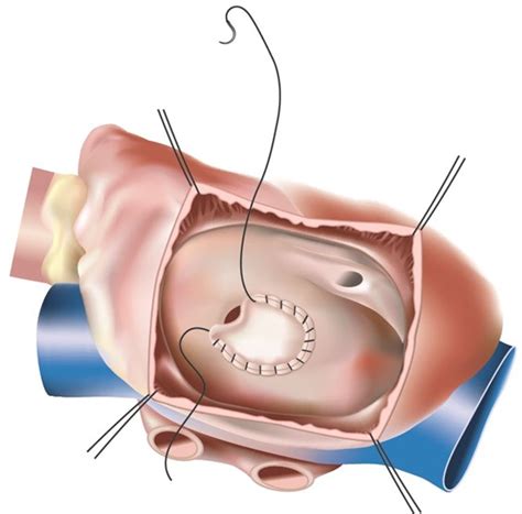 Cardiac Surgery - Minimally Invasive Atrial Septal Defect (ASD) Closure