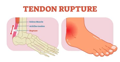 What Does A Tendon Tear Feel Like? Understanding The Pain