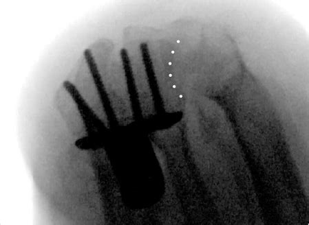 17 Common Errors of Volar Plate Fixation | Musculoskeletal Key