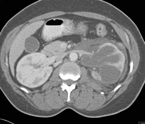 Pyonephrosis Left Kidney due to Obstructing Stone in Ureter - Kidney ...