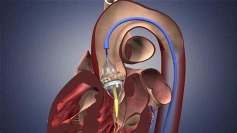 FDA Approval -- SAPIEN Transcatheter Aortic Valve