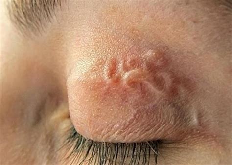 Human dirofilariasis caused by infection with Dirofilaria worms(a genus ...