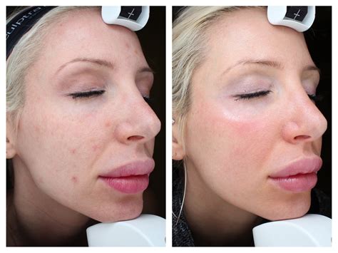 Before and After: my Halo Laser Treatment Results! — Med-E-Spa