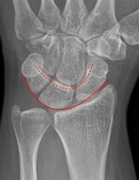 EMRad: Radiologic Approach to the Traumatic Wrist