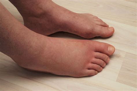 What Causes Swollen Feet and Ankles? – My FootDr