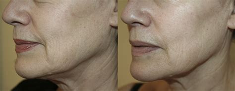 RF Skin Tightening In Boston & Wellesley | SkinHealth