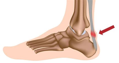 Achilles Tendonitis - St. Augustine - All About Feet & Legs