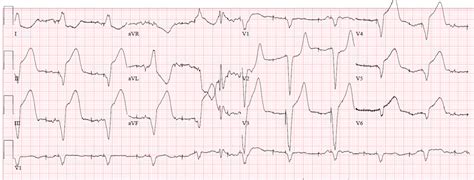 Dr. Smith's ECG Blog: Can you see through this paced rhythm?