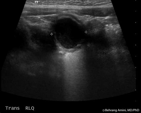 Roentgen Ray Reader: Enteric Duplication Cyst