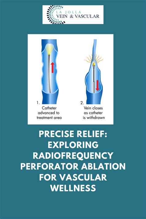 Vein & Vascular Treatment | Perforator Veins