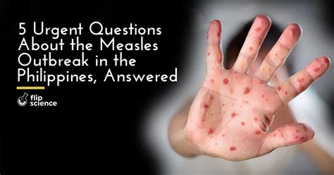 5 urgent questions about the Philippine measles outbreak, answered ...