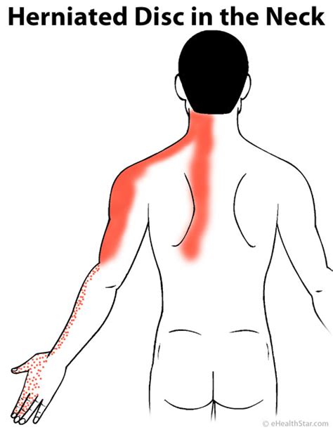 Herniated Disc In the Neck and Lower Back: Symptoms, Treatment ...