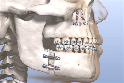 Corrective Jaw Surgery | San Diego | West Coast Oral Surgery