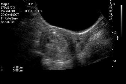 Introduction to Molar Pregnancy – Charing Cross Gestational Trophoblast ...