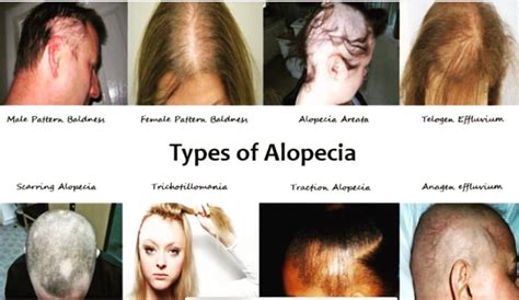 The Different Types of Alopecia Hair Loss – BlackHairandSkincare