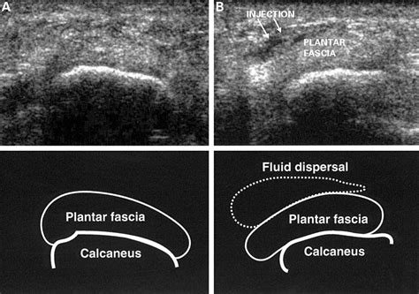 Ultrasound guided injection of plantar fasciitis | Annals of the ...