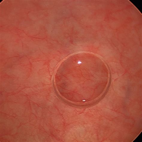 What is a Cystoscopy? - Dr Vivien Wong