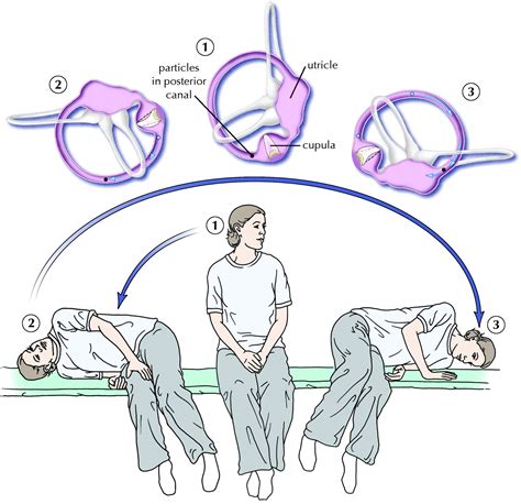 Home Epley Maneuver Diagram