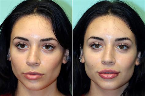 Lip Augmentation photos | Chevy Chase, MD | Patient 17548