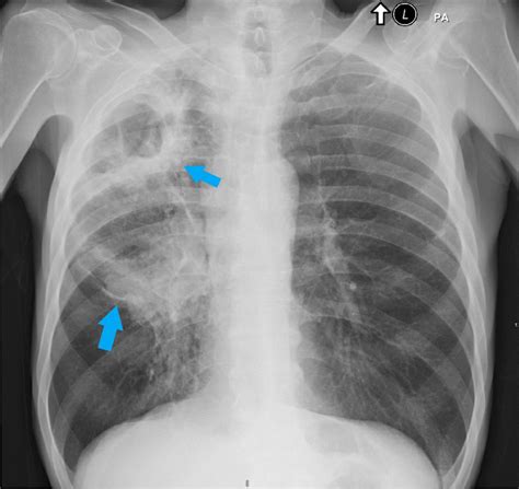 Chest radiograph showing large cavitary lesion in the right upper lung ...