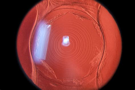 Status post YAG laser treatment