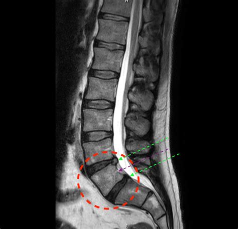 “Lumbarised S1” – The transitional (potentially mobile) lumbosacral ...