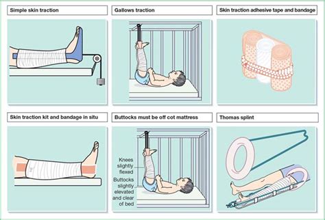 Skin traction | Nurse Key