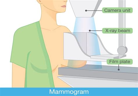 Mammogram | Everything You Need to Know About Mammograms - Left Side Pains