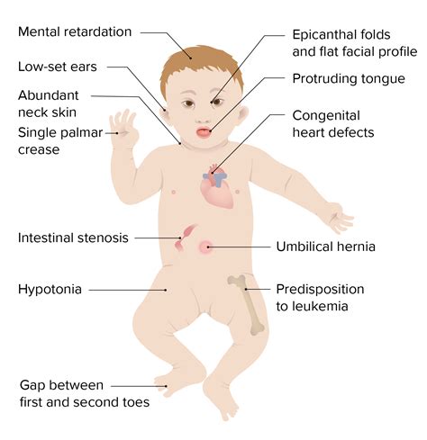 Epicanthal Folds Trisomy 21