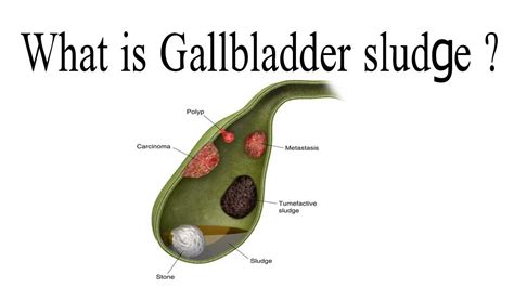 Gallbladder Sludge