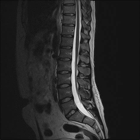 Lumbar Spine Mri Mri Scan Images Lumbar Spine Spine Anatomy Mri ...