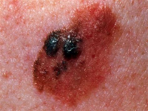 Stage 4 melanoma: Survival rate, pictures, and treatment